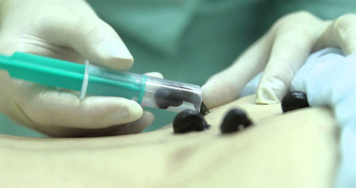фото гирудотерапия лечение пиявками в москве красногорске